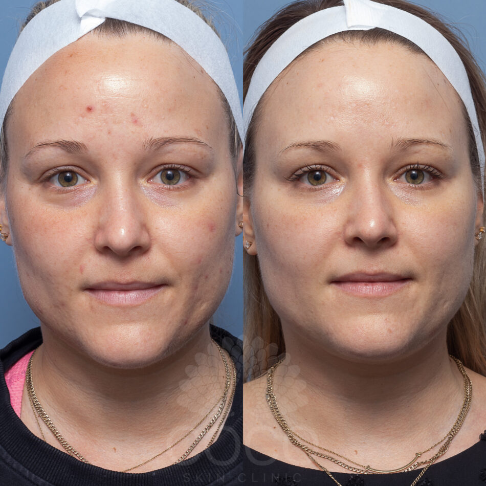Deep Sea Peel | Coco Skin Clinic