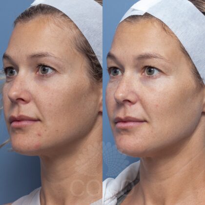 APRILFEATHERBY120785-BA Skin Needling 2