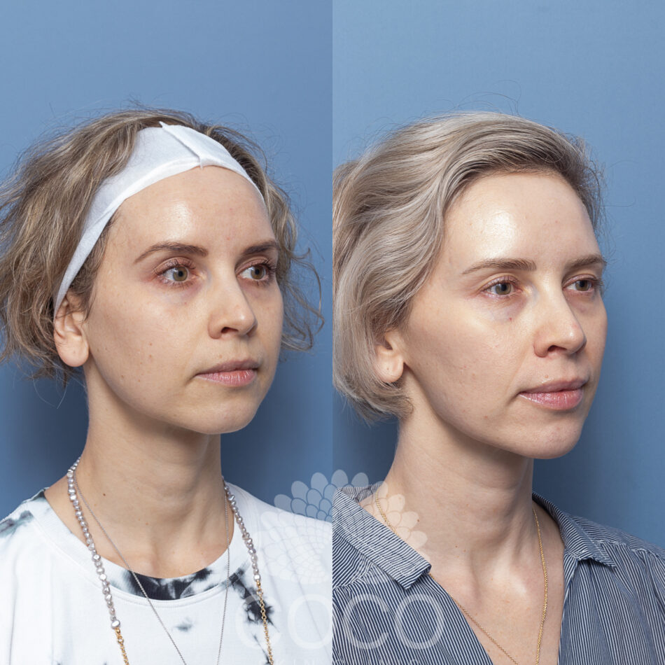 Alya Haydt Needling, HydraFacial (1)