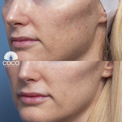 Smaller Pores | BBL Skin Rejuvenation