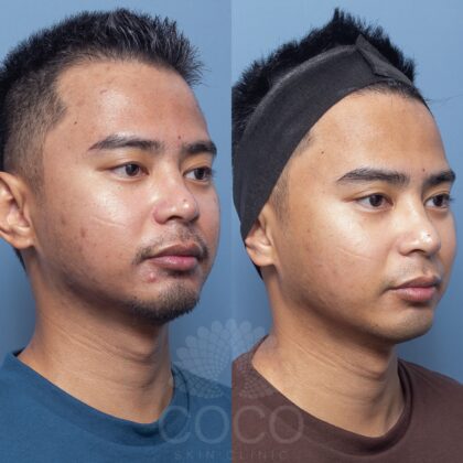 DAVE B SKIN NEEDLING 1 (1)