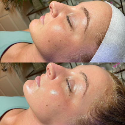 Hydrafacial exfoliate