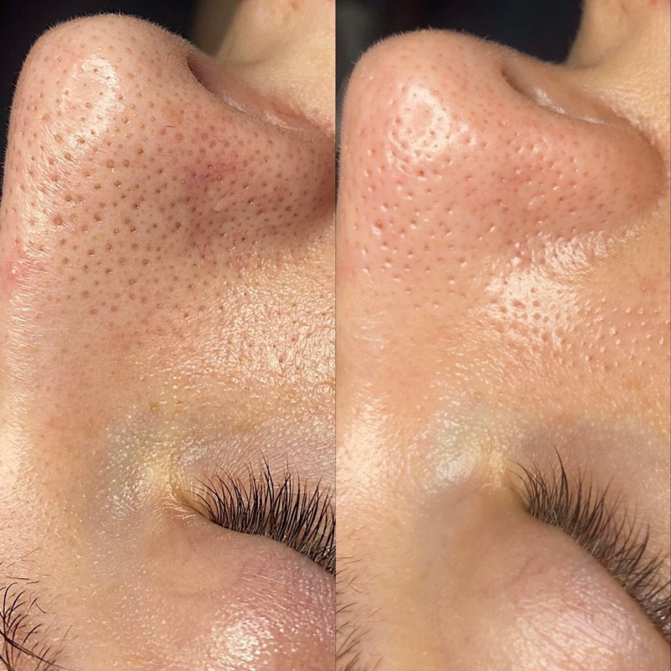 Hydrafacial cleanse
