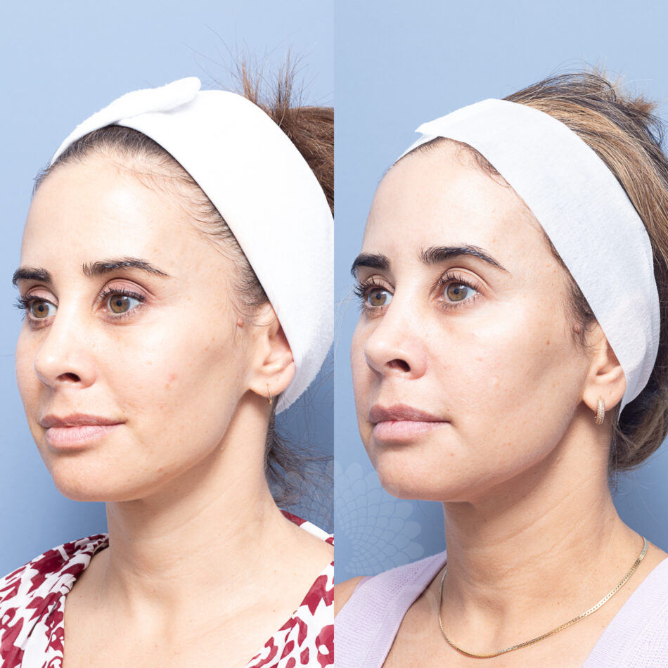 KATISCOE180678-BAPOWERPEEL1