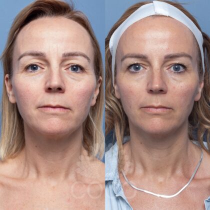 Louise Mansell - Copy - SKin needling, WR Under eye SKin tyte (1)