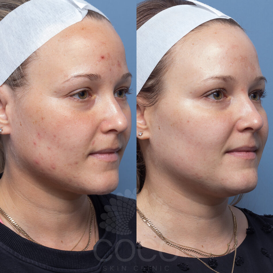 NICOLEBILMAN ENZYME PEEL (1)