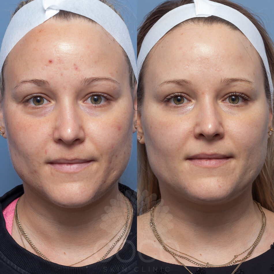 NICOLEBILMAN. ENZYME PEEL (1)