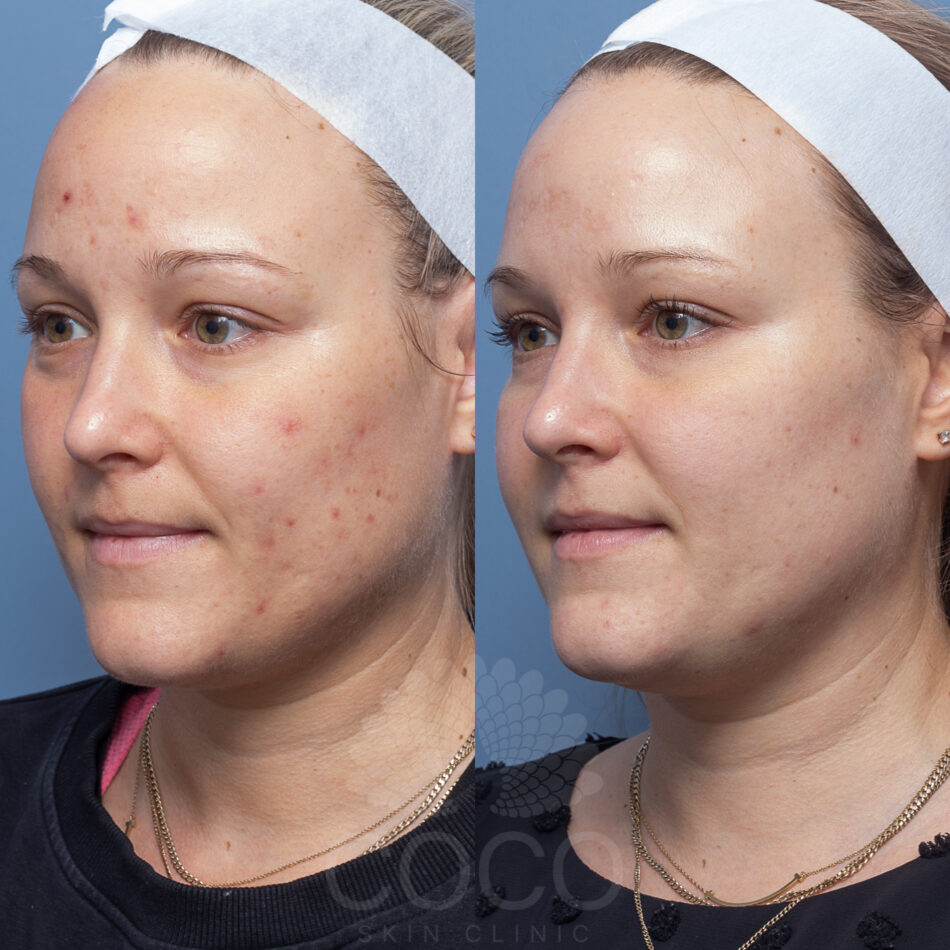 NICOLEBILMAN. ENZYME PEEL 2 (1)