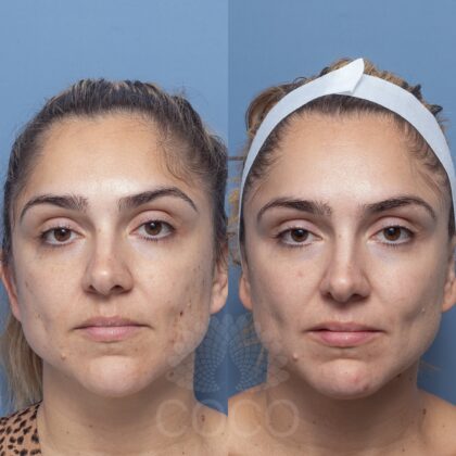SKYESUMMER BA- HydraFacial And Skin Needling 3