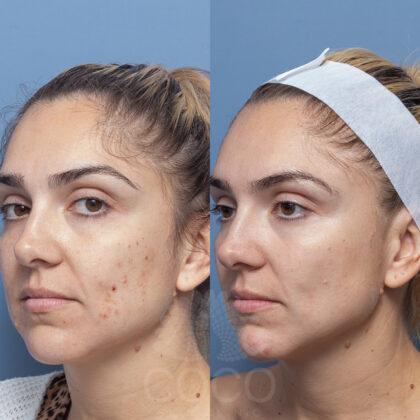 Firmer Skin | Skin Needling