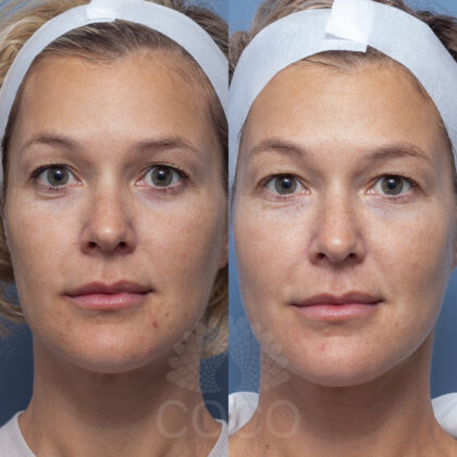 Reduced acne scarring