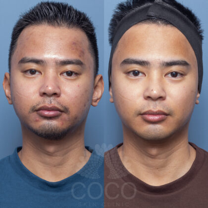 Skin Needing | Coco Skin Clinic