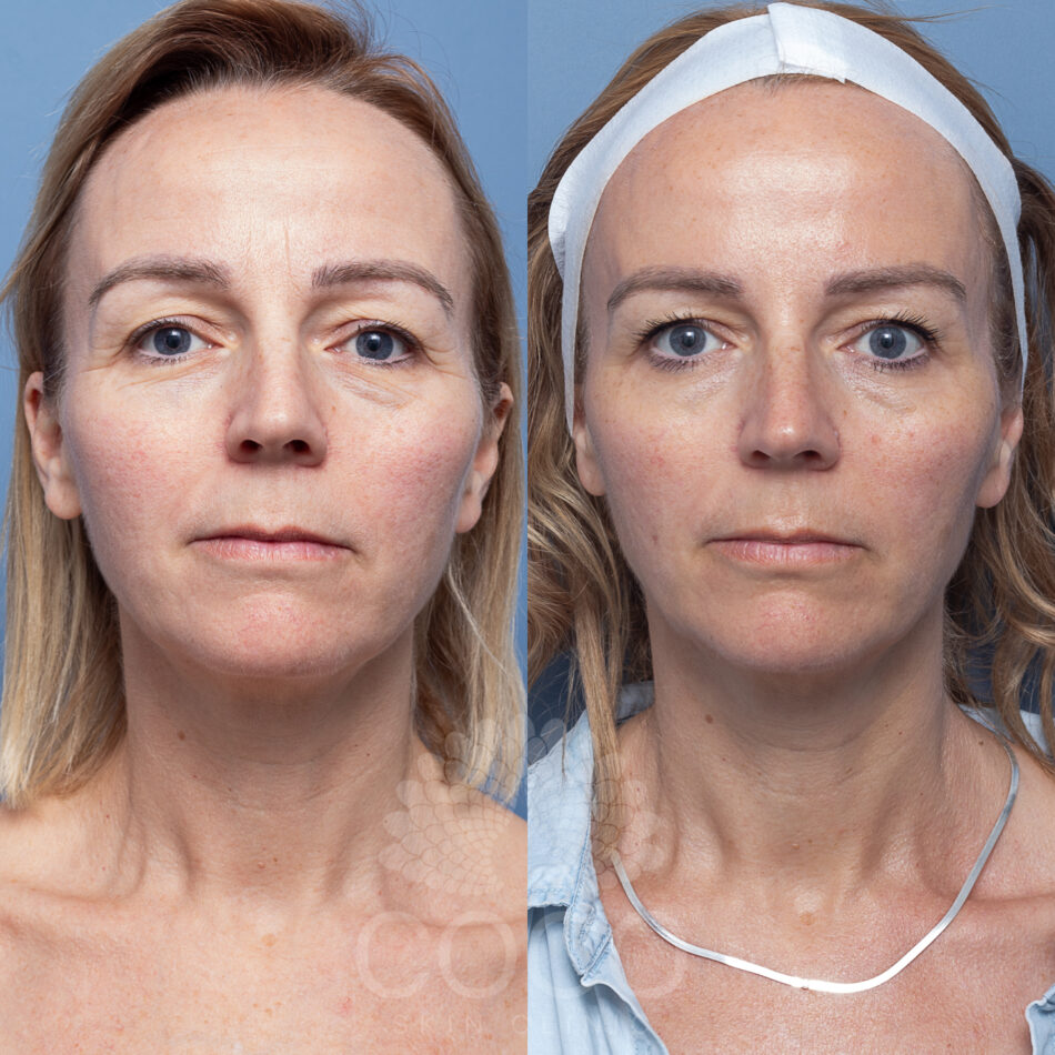 Skin Tyte | Coco Skin Clinic