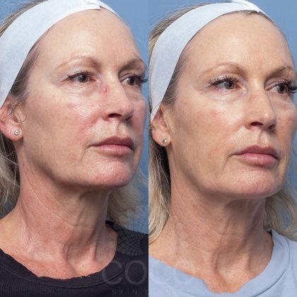 coco-skin-clinic-lines-wrinkles-before-after-01.jpg