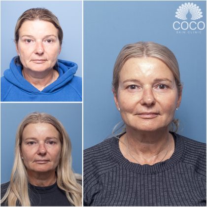 coco-skin-clinic-lines-wrinkles-before-after-04.jpg